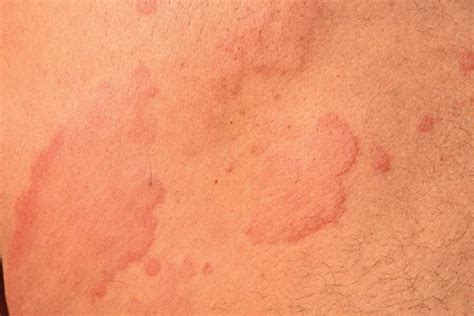 What Causes Hives? Everything You Need to Know About Urticaria - Better ...