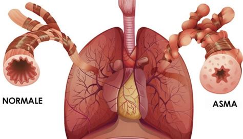 Bronchial asthma: symptoms and treatment | Emergency Live