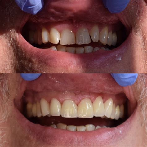 Before and After Veneers Procedure | Dr. Christian Chung, D.D.S.