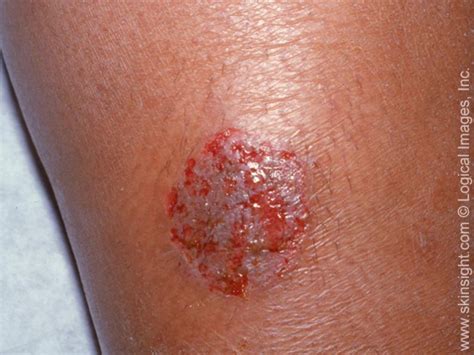 Nummular Eczema – Symptoms and causes | National Eczema Association