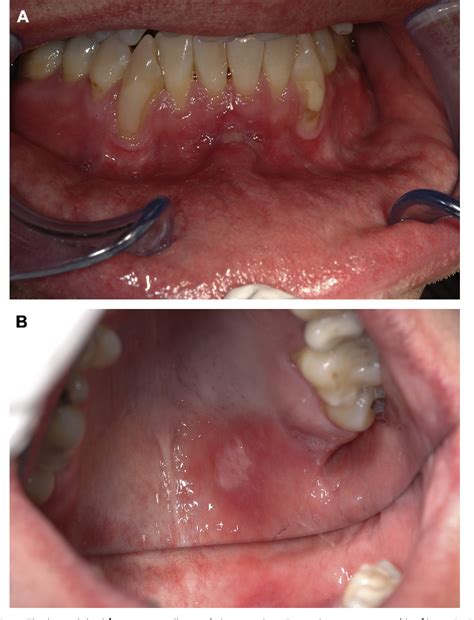 Figure 1 from Oral syphilis: a series of 5 cases. | Semantic Scholar