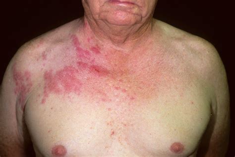 Shingles Rash On Body