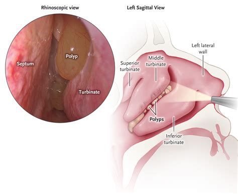 Nasal Polyps