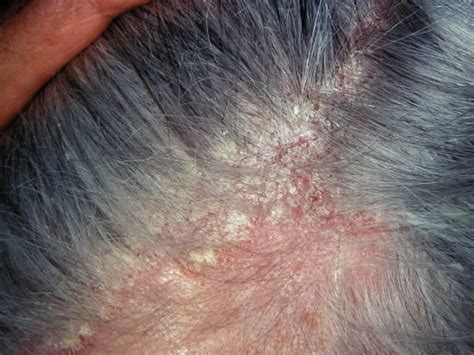 Mild Scalp Dermatitis