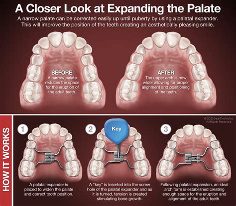 Palatal Expansion