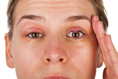 Eyelid Swollen: Symptoms, Causes, Treatment - Angleton ER