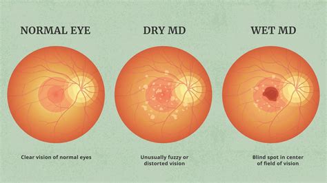 Wet vs. Dry Age-Related Macular Degeneration (AMD)