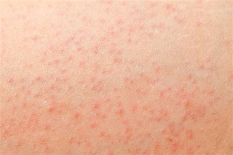 Petechiae: Causes, Symptoms, Treatment & When to Worry - Tua Saúde