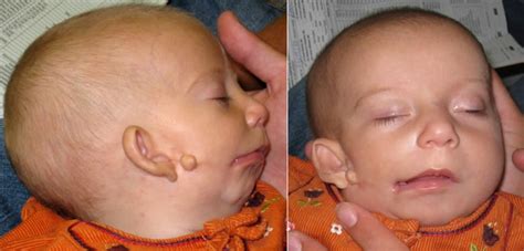 Hemifacial microsomia causes, signs, symptoms, diagnosis & treatment