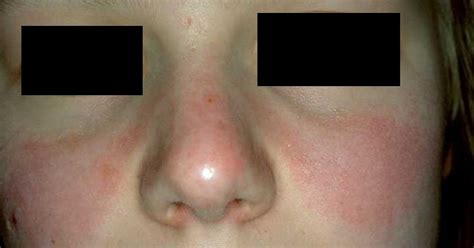 👉 Lupus Rash - Pictures, Symptoms, Causes, Treatment (December 2021)