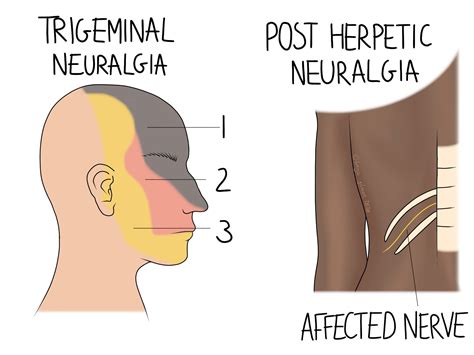 Neuralgia