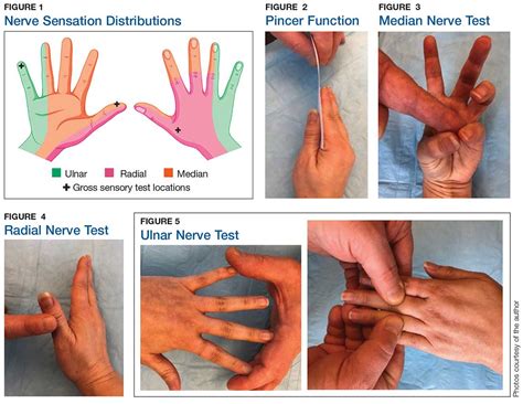 Median Nerve Palsy