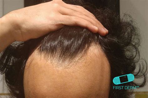 Alopecia areata, what is it? Symptoms, causes and treatments