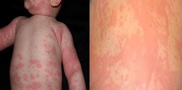 HIVES or Urticaria