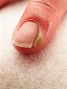 Infection Around Fingernail Cuticle - Awesome Nail