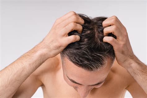 Scabs And Sores On Scalp: Pictures, Causes, Treatment, 41% OFF