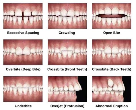 Underbite vs. Overbite: What’s the Difference and How are They Treated ...