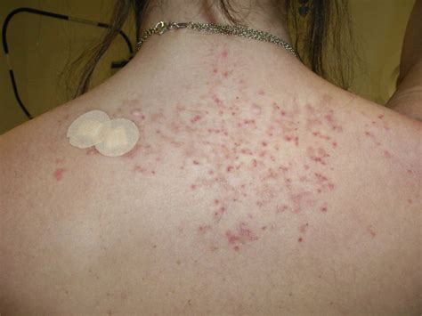 Prurigo pigmentosa causes, symptoms, diagnosis & treatment