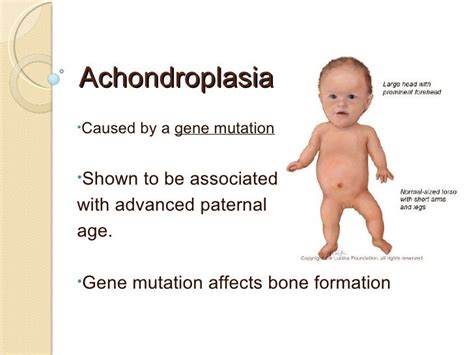 Achondroplasia