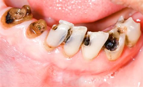 Tooth Decay Molar Treatment