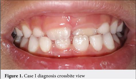 [PDF] Treatment of Anterior Dental Crossbite with Different Methods in ...