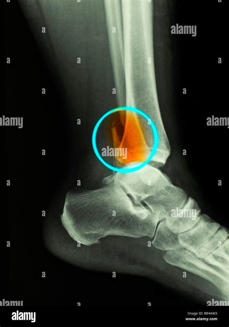 X-ray showing a bimalleolar ankle fracture in a 50 year old woman Stock ...