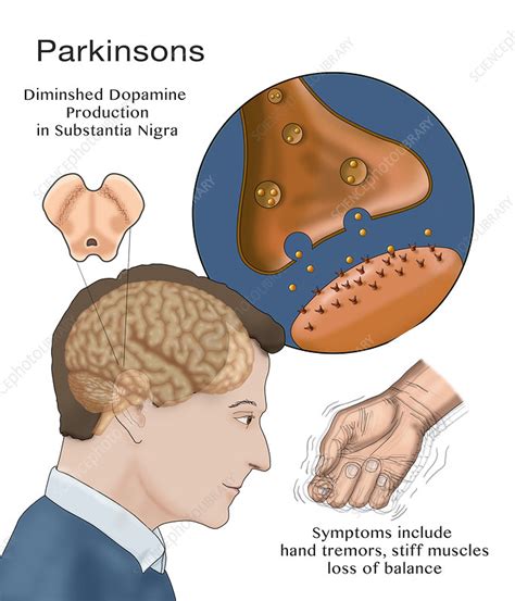 Dopamine & Parkinson's, Illustration - Stock Image - C036/5458 ...