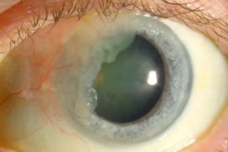 Tumors of the Conjunctiva | Ento Key