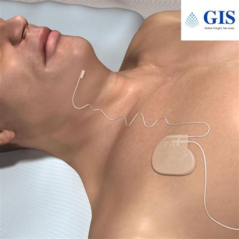 Sleep Apnea Implants Market Analysis and Forecast to 2033: