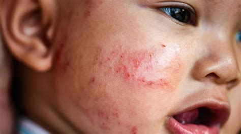 Những điều cần biết về Eczema ở trẻ em - Viam Clinic