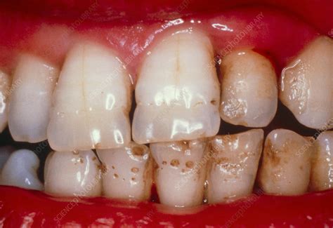 Enamel Hypoplasia