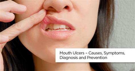 Understanding Mouth Ulcers: Causes, Symptoms, and Treatment