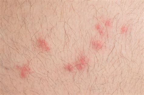 Flea Allergy Dermatitis On Humans