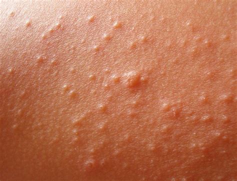 Heat Rash: Pictures, Symptoms, Causes, Treatment, Home Remedies - HubPages