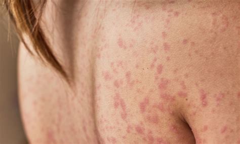 Amoxicillin Rash: What It Is, What It Looks Like, and How to Treat It ...