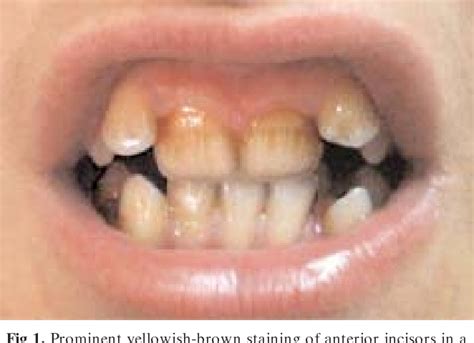 Figure 1 from Doxycycline-induced staining of permanent adult dentition ...