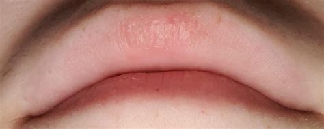 what is this odd dry patch on my upper lip : r/medical