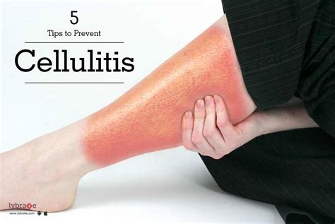 5 Tips to Prevent Cellulitis - By Dr. Rameshwar Madhukar Rao Gutte ...