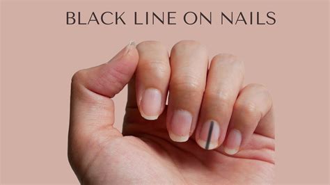 Spotting a Black Line on Nails and What it Signifies - VIMS