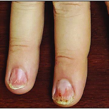 Diffuse onychoptosis involving all fingernails | Download Scientific ...