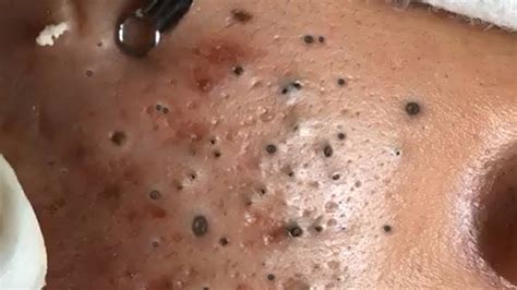 Big Cystic Acne Blackheads Extraction Blackheads & Removal Pimple ...