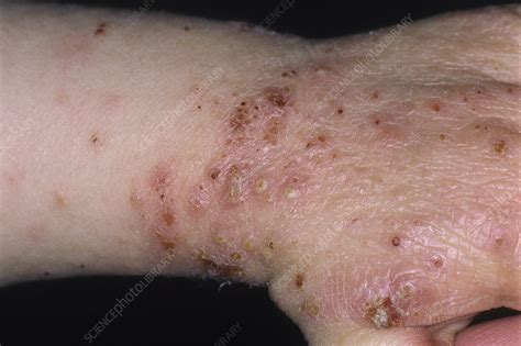 Eczema herpeticum - Stock Image - C053/1929 - Science Photo Library