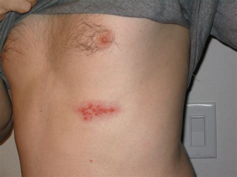 Herpes Zoster (Shingles) | Concise Medical Knowledge