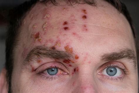 What You Need to Know About Shingles of the Eye: Scott Beeve, M.D ...