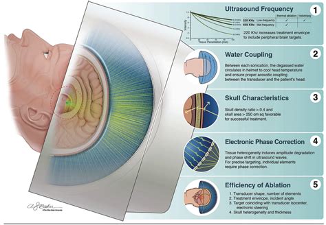 What is all the 'FUS' about with focused ultrasound for Parkinson's ...