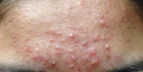 Folliculitis On Face Treatment - Doctor Heck