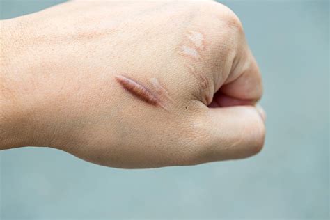 Keloid Scar Treatment In Singapore: A Dermatologist’s Guide - Assurance ...