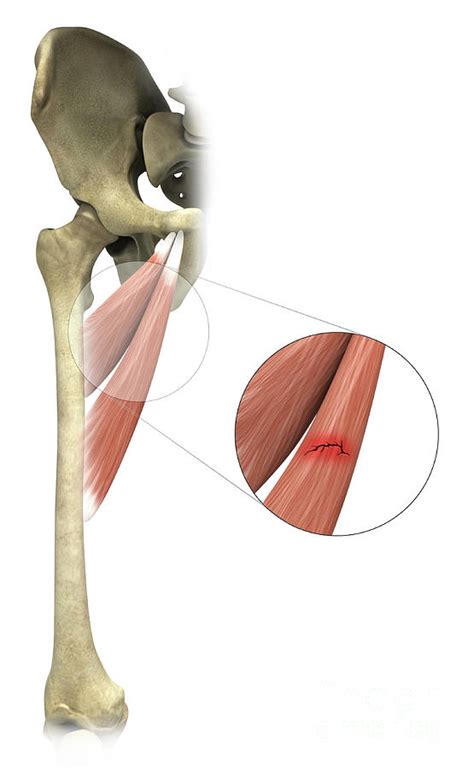 Adductor Muscle Strain Photograph by Medical Graphics/michael Hoffmann ...