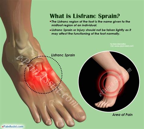 Top of foot pain symptoms causes treatment – Artofit