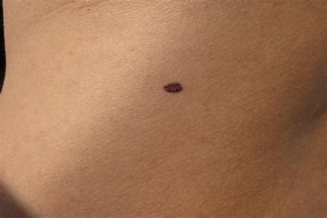 Skin Moles To Worry About